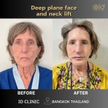 نتائج شد الوجه والرقبة العميق قبل وبعد في ID Clinic بانكوك تايلاند