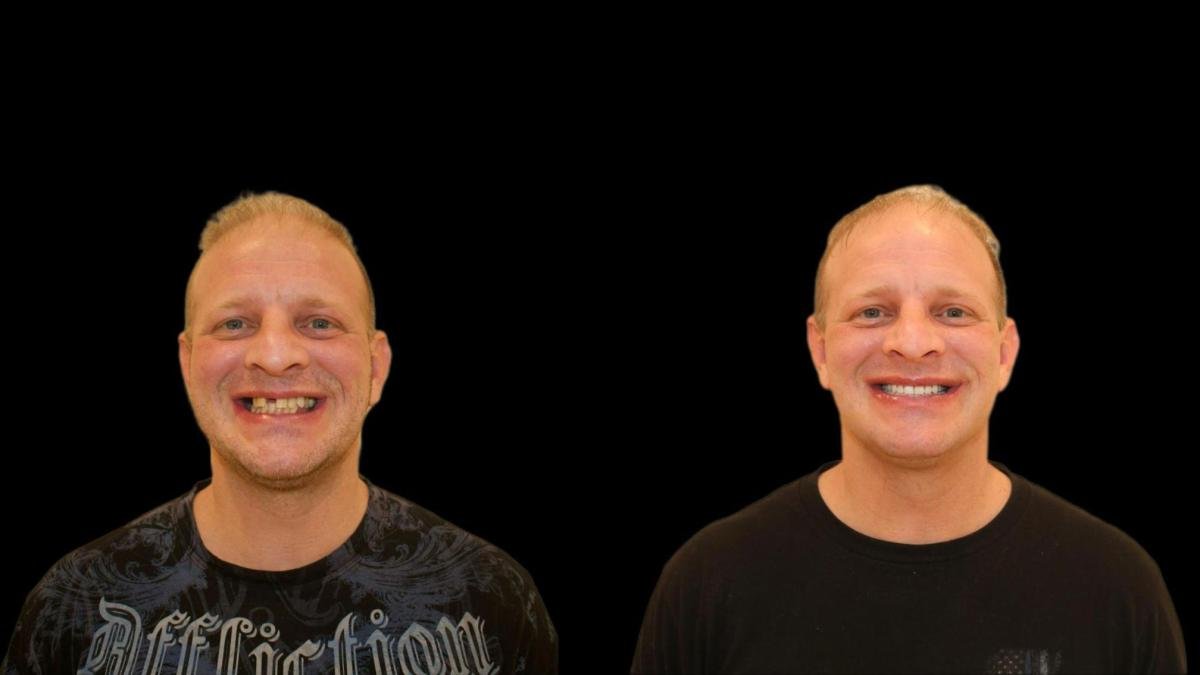 Resultados antes y después de implantes dentales: sonrisa restaurada y transformación dental