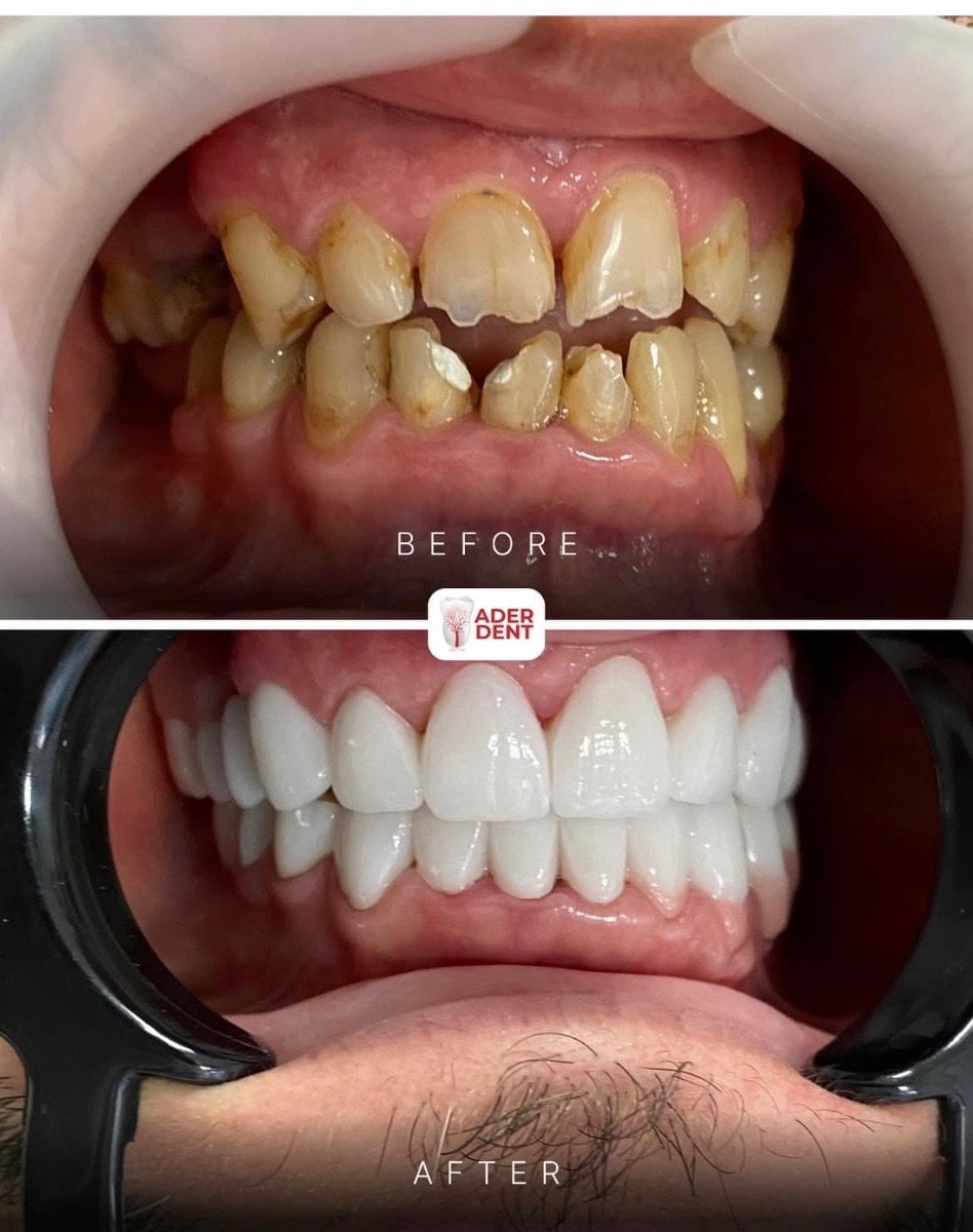 Resultados de antes y después de smile makeover en Ader Dent Oral and Dental Health Polyclinic
