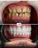 Smile makeover before and after results at Ader Dent Oral and Dental Health Polyclinic