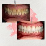 Smile makeover before and after results at Ader Dent Oral and Dental Health Polyclinic