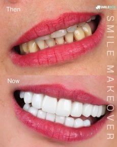 نتيجة قبل وبعد فينير إيماكس في SmileBox Dental Clinic - Thonglor، تجميل الابتسامة
