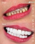 نتيجة قبل وبعد فينير إيماكس في SmileBox Dental Clinic - Thonglor، تجميل الابتسامة