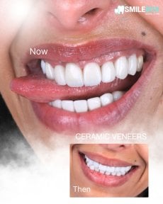 نتيجة قبل وبعد عدسات الأسنان الخزفية في SmileBox Dental Clinic - Thonglor