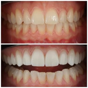 نتائج قبل وبعد ترابط الأسنان في Nifa Dent International – تحسين جمالية الابتسامة