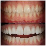 نتائج قبل وبعد ترابط الأسنان في Nifa Dent International – تحسين جمالية الابتسامة