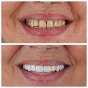 نتائج قبل وبعد ترابط الأسنان في Nifa Dent International – تحسين جمالية الابتسامة