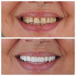 نتائج قبل وبعد ترابط الأسنان في Nifa Dent International – تحسين جمالية الابتسامة