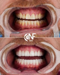 نتائج قبل وبعد ترابط الأسنان في Nifa Dent International – تحسين جمالية الابتسامة