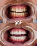 نتائج قبل وبعد ترابط الأسنان في Nifa Dent International – تحسين جمالية الابتسامة