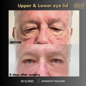 before-after photo lower-eyelid-surgery