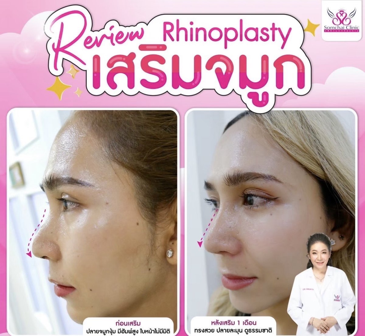 نتائج تجميل الأنف قبل وبعد في Somchai Clinic، إعادة تشكيل الأنف بمظهر طبيعي