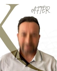 before-after photo peresadka-volos