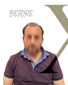 before-after photo peresadka-volos