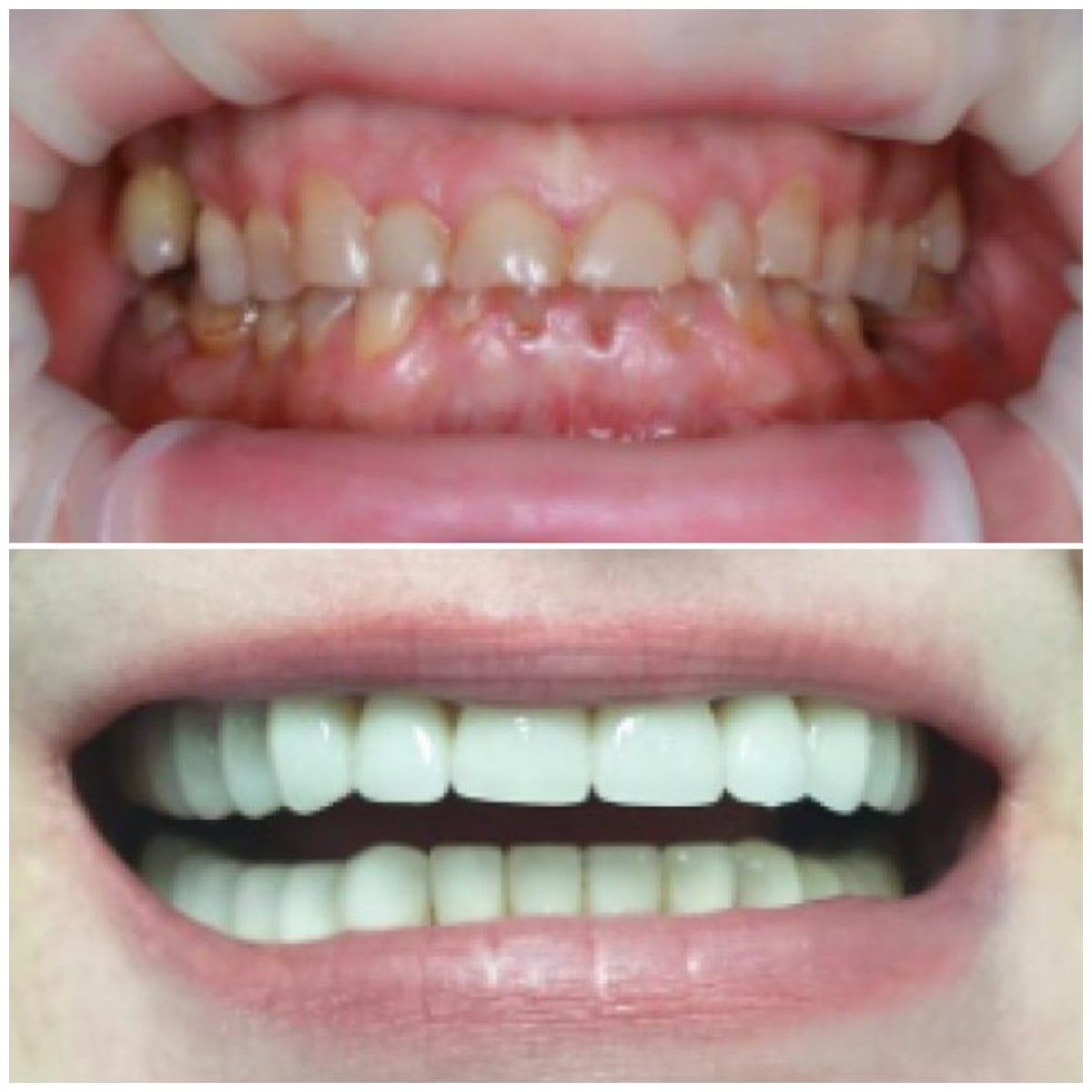 Resultado antes y después de carillas en Factor Smile Dental Clinic, transformación visible