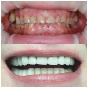 Resultado antes y después de carillas en Factor Smile Dental Clinic, transformación visible