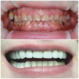Resultado antes y después de carillas en Factor Smile Dental Clinic, transformación visible
