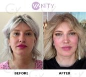 Результати до і після підтяжки обличчя у Vanity Cosmetic Surgery Center, омолодження
