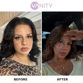 Resultados de rinoplastia antes y después en Vanity Cosmetic Surgery Center, nariz refinada