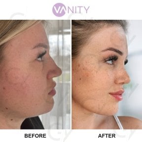 نتائج عملية تجميل الأنف قبل وبعد في Vanity Cosmetic Surgery Center، إعادة تشكيل الأنف