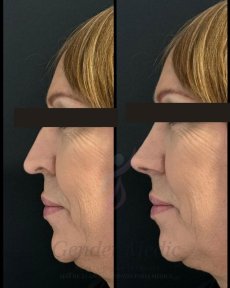 Before and after rhinoplasty results at Gender Medic Unit, improved nose profile and contour