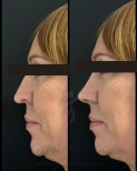 Before and after rhinoplasty results at Gender Medic Unit, improved nose profile and contour