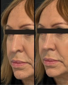 Before and after rhinoplasty results at Gender Medic Unit, improved nose shape and contour