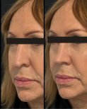 Before and after rhinoplasty results at Gender Medic Unit, improved nose shape and contour