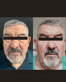 Before and after blepharoplasty results at Gender Medic Unit, visible eyelid correction improvement