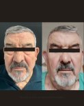 Before and after blepharoplasty results at Gender Medic Unit, visible eyelid correction improvement