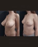 Before and after breast reduction results at Gender Medic Unit, improved breast contour