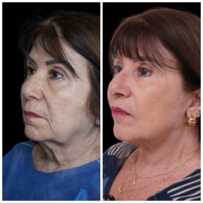 before-after photo tightening-of-facial-skin-facelift