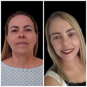before-after photo tightening-of-facial-skin-facelift