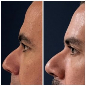 before-after photo tightening-of-facial-skin-facelift