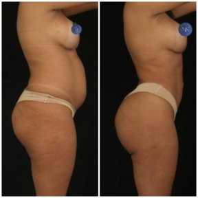 before-after photo 360-liposuction