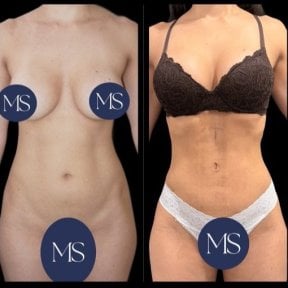 before-after photo 360-liposuction