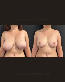 before-after photo breast-reduction