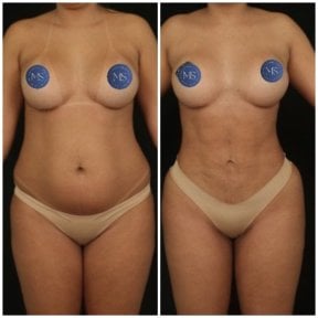 before-after photo 360-liposuction
