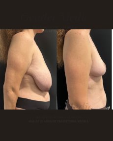 before-after photo mastopexy-breast-lift-contour-plastics