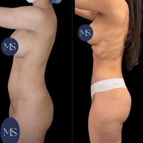 before-after photo 360-liposuction