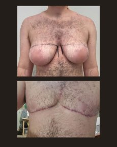 before-after photo body-masculinization-surgery