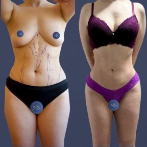 before-after photo 360-liposuction