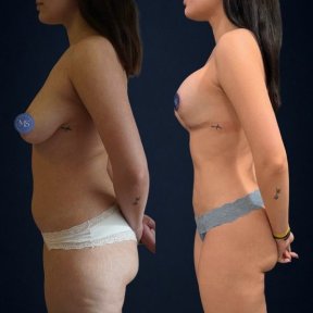 before-after photo 360-liposuction