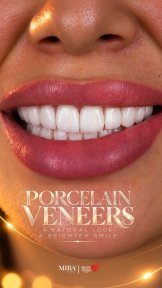 before-after photo installation-of-a-veneer