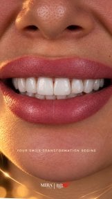 before-after photo installation-of-a-veneer