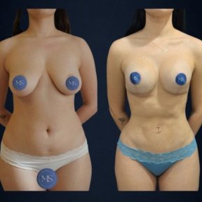 before-after photo 360-liposuction
