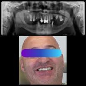 before-after photo all-on-4-dental-implants