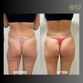 before-after photo brazilian-butt-lift