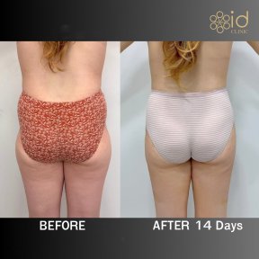 before-after photo brazilian-butt-lift