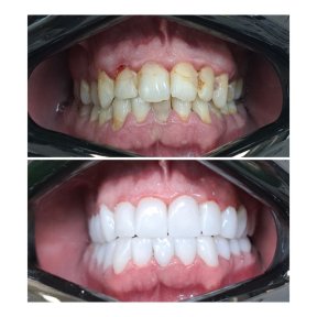 before-after photo zirconia-crown-installation